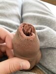 Broken foreskin porn: 5 Nude Pics