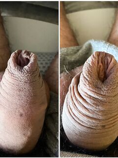 Foreskin stretching: 3 Nude Pics